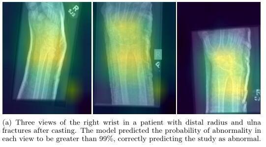 吴恩达团队公布最大医学影像数据集 MURA，基于深度学习检测骨骼疾病