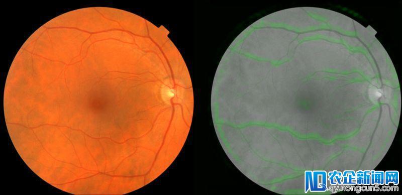 谷歌AI算法新突破：看看眼睛就知道你会不会得心脏病