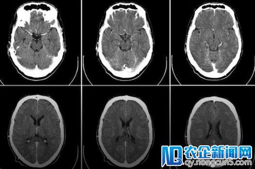 科学家发现修复大脑方法：中风或通过药物治愈