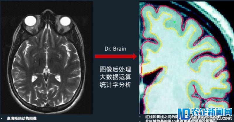 自主搭建中国人群大脑影像学数据库，人工智能诊断平台脑医生完成数千万Pre-A轮融资