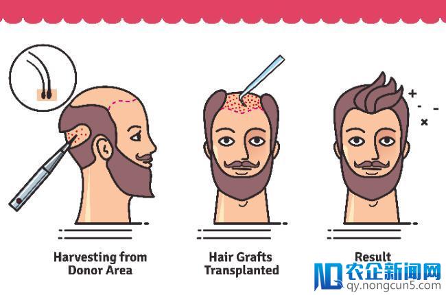 秃顶的朋友稳住，这项新技术能让你的头发「无限再生」