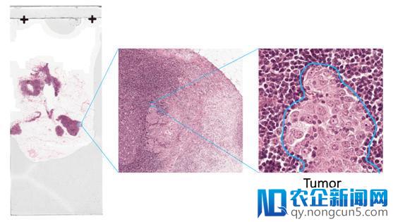 百度发力医疗AI，肿瘤检测再次取得突破